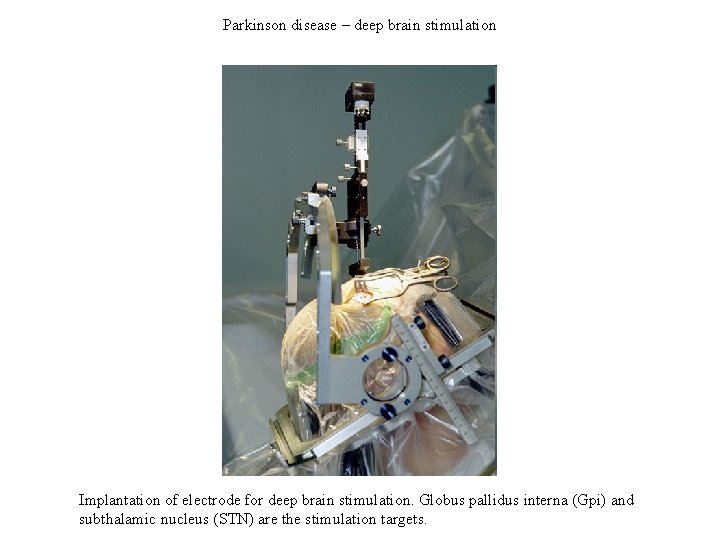 Parkinson disease – deep brain stimulation Implantation of electrode for deep brain stimulation. Globus