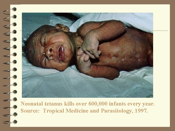 Neonatal tetanus kills over 600, 000 infants every year. Source: Tropical Medicine and Parasitology,