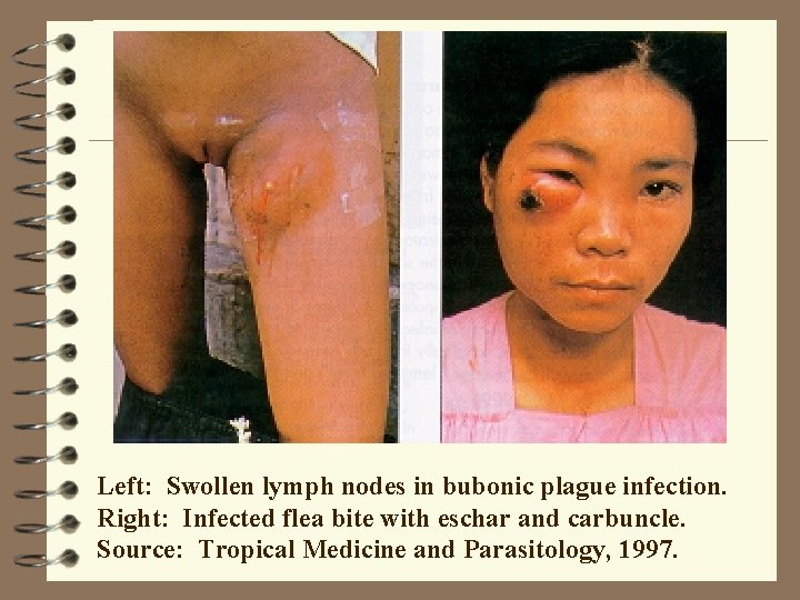 Left: Swollen lymph nodes in bubonic plague infection. Right: Infected flea bite with eschar