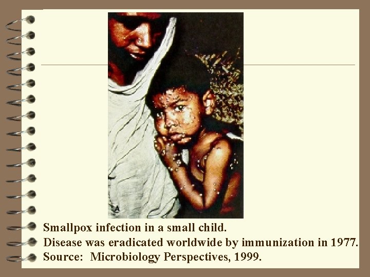 Smallpox infection in a small child. Disease was eradicated worldwide by immunization in 1977.