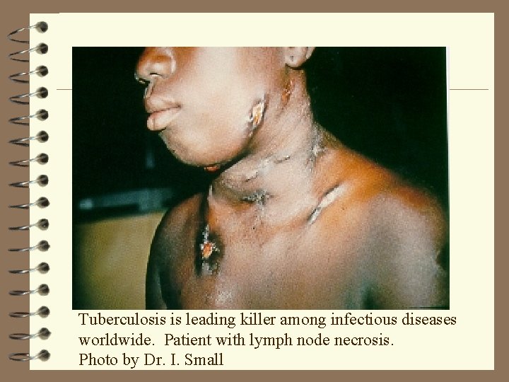 Tuberculosis is leading killer among infectious diseases worldwide. Patient with lymph node necrosis. Photo