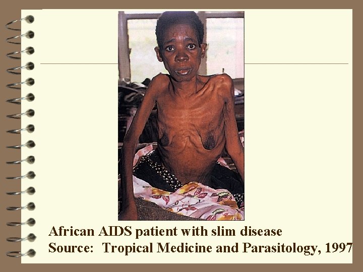 African AIDS patient with slim disease Source: Tropical Medicine and Parasitology, 1997 