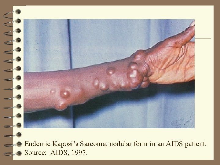 Endemic Kaposi’s Sarcoma, nodular form in an AIDS patient. Source: AIDS, 1997. 