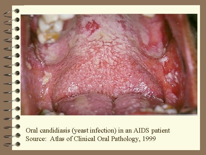 Oral candidiasis (yeast infection) in an AIDS patient Source: Atlas of Clinical Oral Pathology,