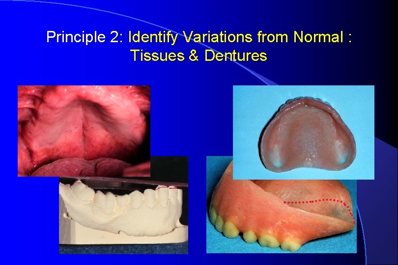 Principle 2: Identify Variations from Normal : Tissues & Dentures 