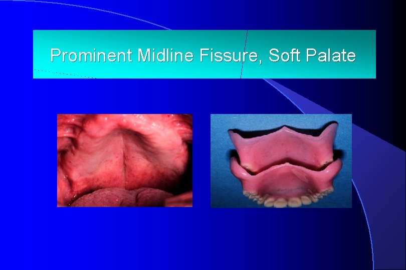 Prominent. Loose Midline. Denture: Fissure, Soft Palate 