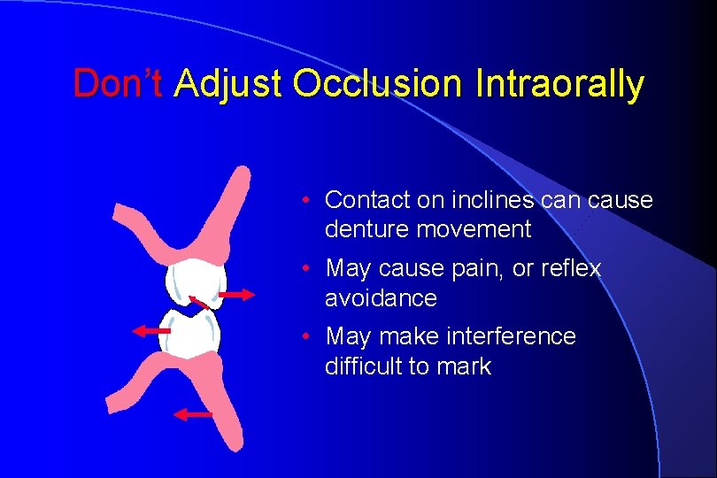 Don’t Adjust Occlusion Intraorally • Contact on inclines can cause denture movement • May