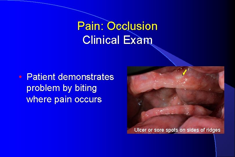 Pain: Occlusion Clinical Exam • Patient demonstrates problem by biting where pain occurs Ulcer