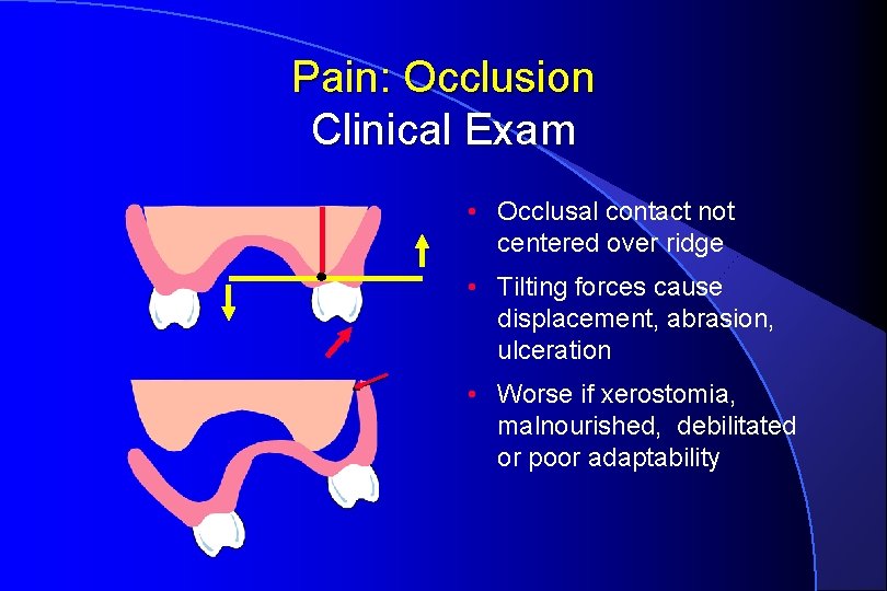 Pain: Occlusion Clinical Exam • Occlusal contact not centered over ridge • Tilting forces