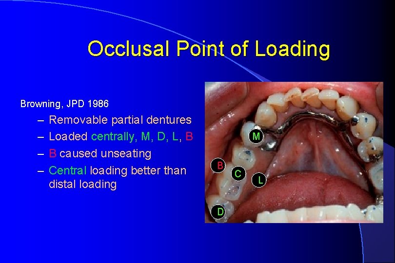Occlusal Point of Loading Browning, JPD 1986 – – Removable partial dentures Loaded centrally,