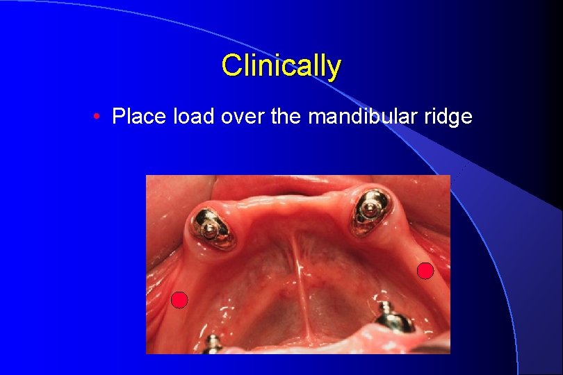 Clinically • Place load over the mandibular ridge 