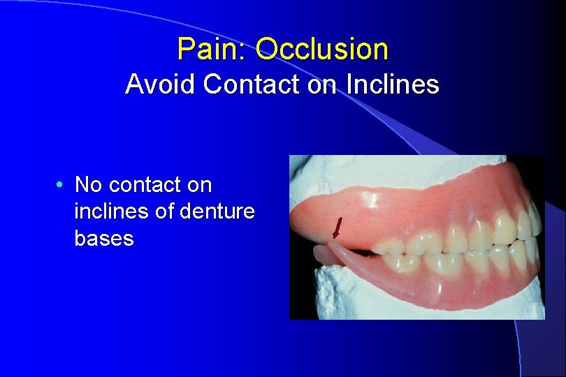 Pain: Occlusion Avoid Contact on Inclines • No contact on inclines of denture bases