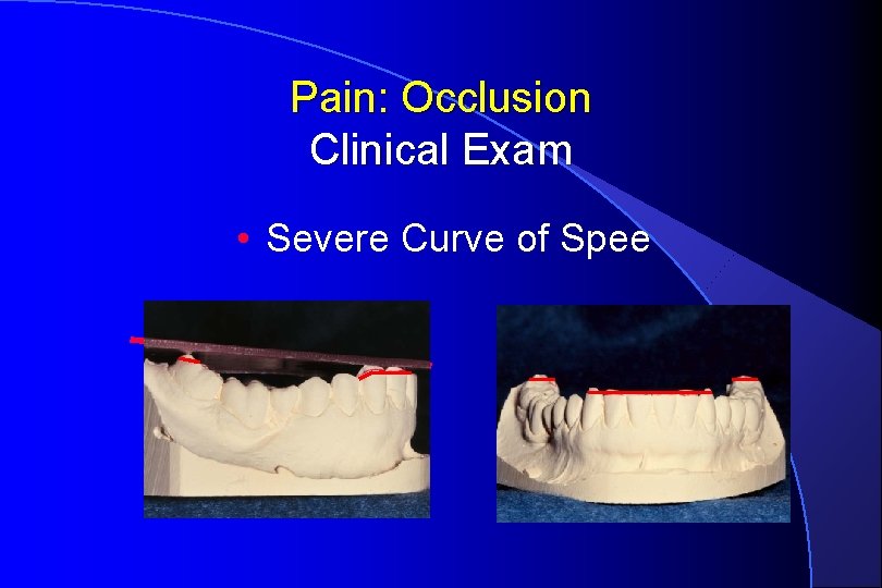 Pain: Occlusion Clinical Exam • Severe Curve of Spee 