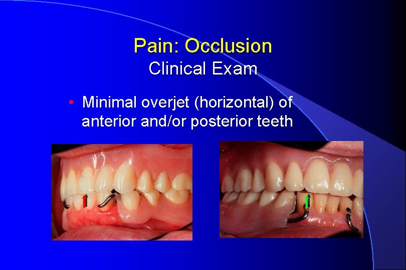 Pain: Occlusion Clinical Exam • Minimal overjet (horizontal) of anterior and/or posterior teeth 