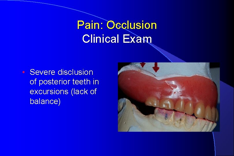 Pain: Occlusion Clinical Exam • Severe disclusion of posterior teeth in excursions (lack of