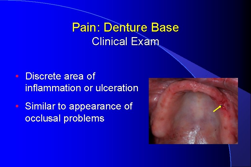 Pain: Denture Base Clinical Exam • Discrete area of inflammation or ulceration • Similar