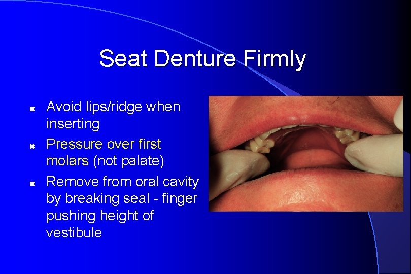 Seat Denture Firmly Avoid lips/ridge when inserting Pressure over first molars (not palate) Remove