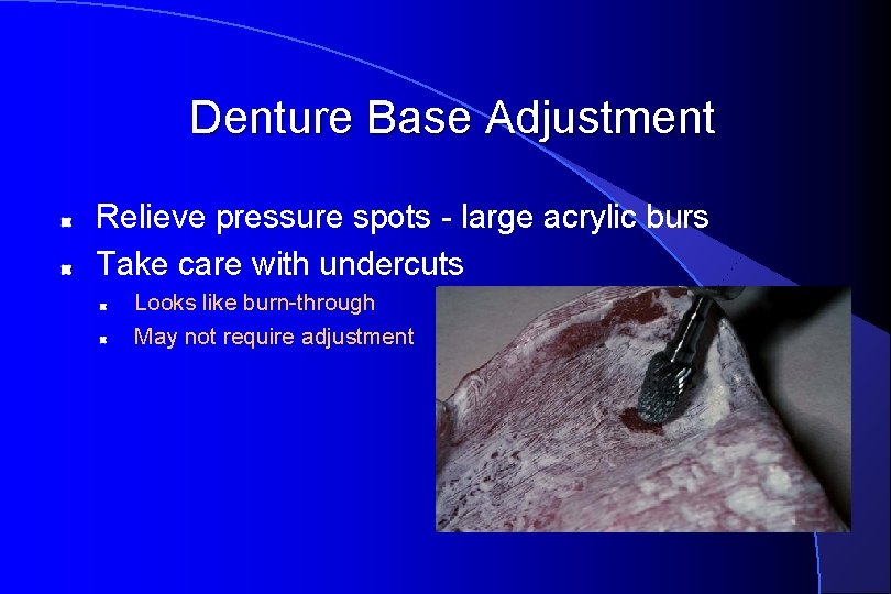 Denture Base Adjustment Relieve pressure spots - large acrylic burs Take care with undercuts