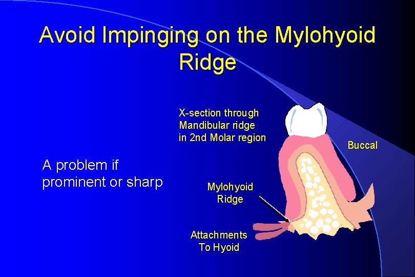 Avoid Impinging on the Mylohyoid Ridge X-section through Mandibular ridge in 2 nd Molar