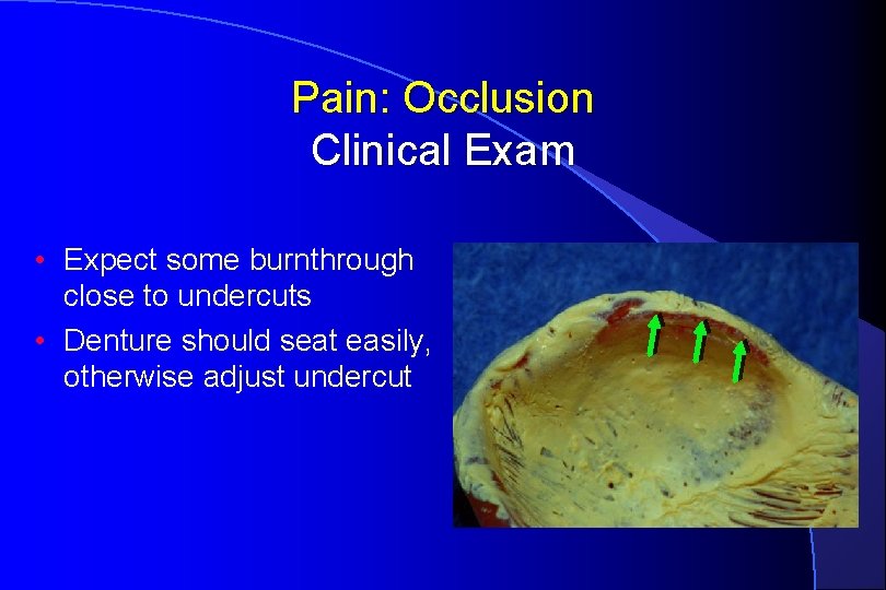 Pain: Occlusion Clinical Exam • Expect some burnthrough close to undercuts • Denture should