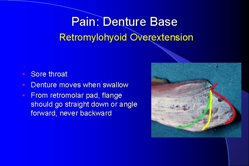 Pain: Denture Base Retromylohyoid Overextension • Sore throat • Denture moves when swallow •