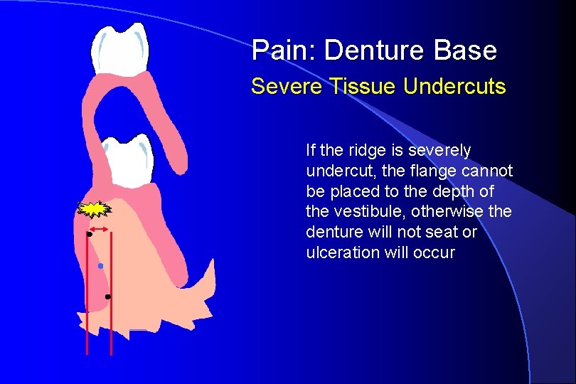 Pain: Denture Base Severe Tissue Undercuts If the ridge is severely undercut, the flange