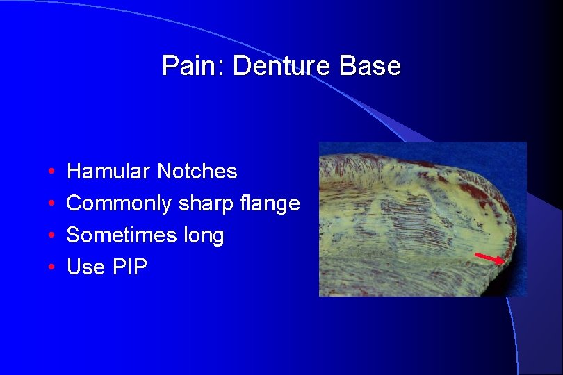 Pain: Denture Base • • Hamular Notches Commonly sharp flange Sometimes long Use PIP