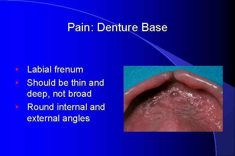 Pain: Denture Base • Labial frenum • Should be thin and deep, not broad