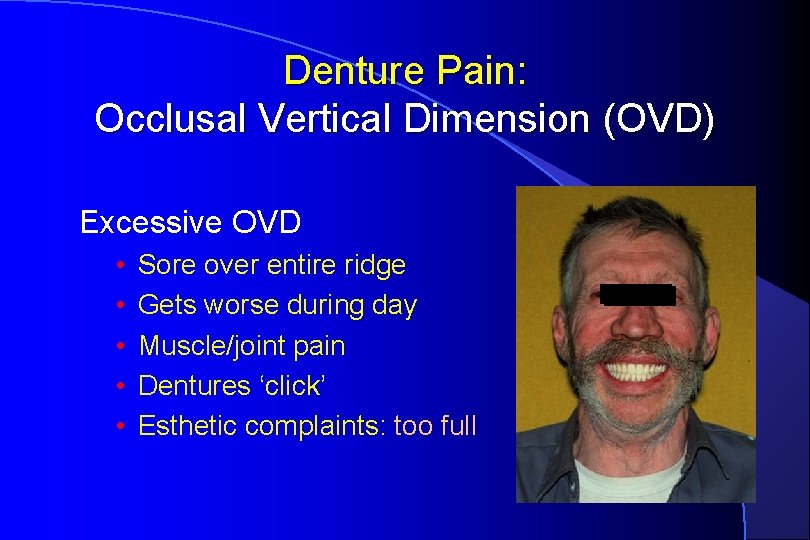 Denture Pain: Occlusal Vertical Dimension (OVD) Excessive OVD • • • Sore over entire