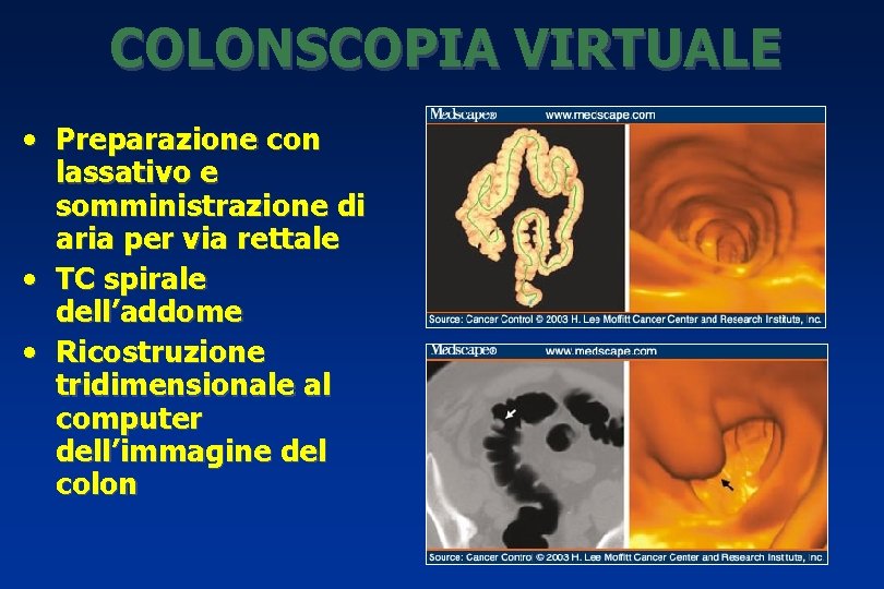 COLONSCOPIA VIRTUALE • Preparazione con lassativo e somministrazione di aria per via rettale •