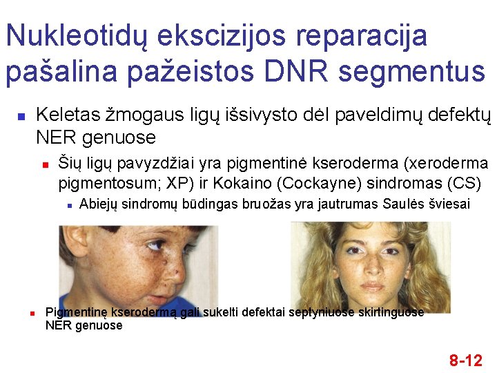 Nukleotidų ekscizijos reparacija pašalina pažeistos DNR segmentus Keletas žmogaus ligų išsivysto dėl paveldimų defektų