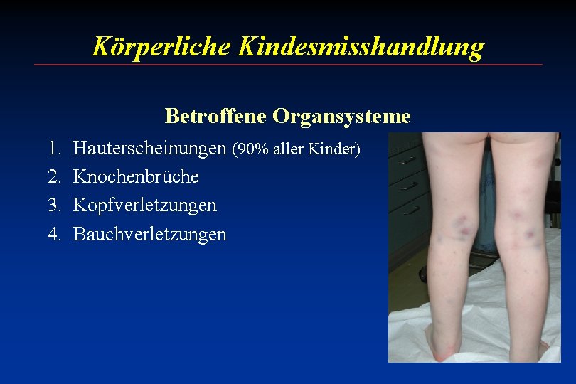 Körperliche Kindesmisshandlung Betroffene Organsysteme 1. 2. 3. 4. Hauterscheinungen (90% aller Kinder) Knochenbrüche Kopfverletzungen