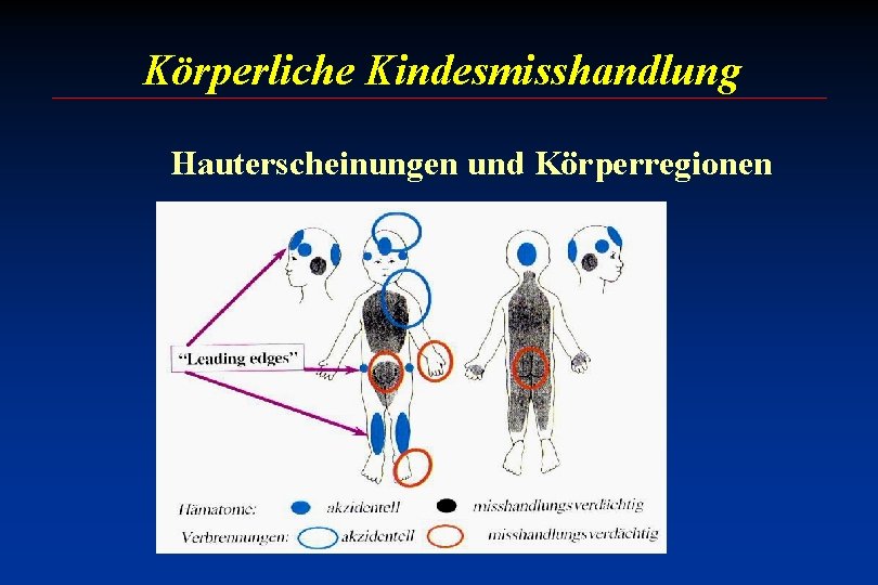 Körperliche Kindesmisshandlung Hauterscheinungen und Körperregionen 