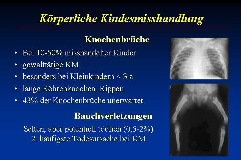 Körperliche Kindesmisshandlung Knochenbrüche • • • Bei 10 -50% misshandelter Kinder gewalttätige KM besonders