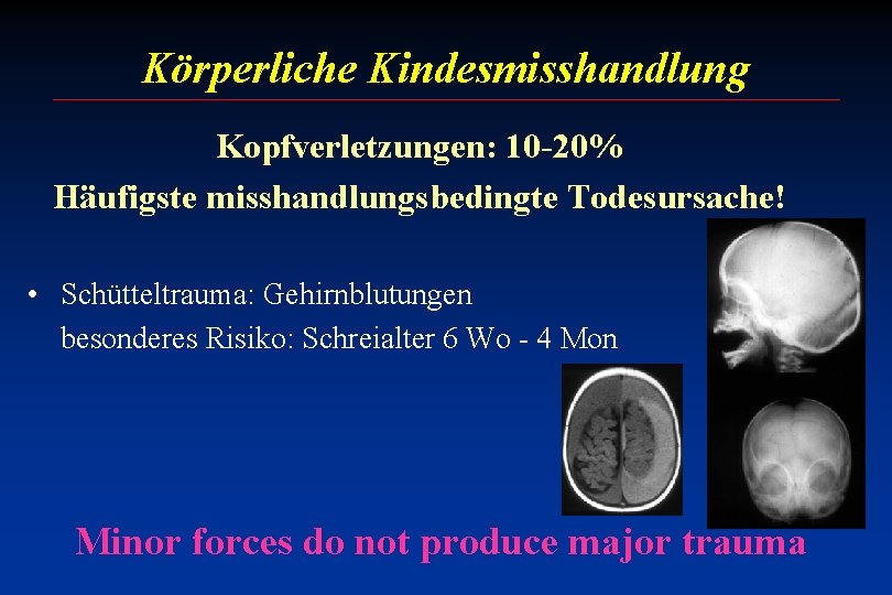 Körperliche Kindesmisshandlung Kopfverletzungen: 10 -20% Häufigste misshandlungsbedingte Todesursache! • Schütteltrauma: Gehirnblutungen besonderes Risiko: Schreialter