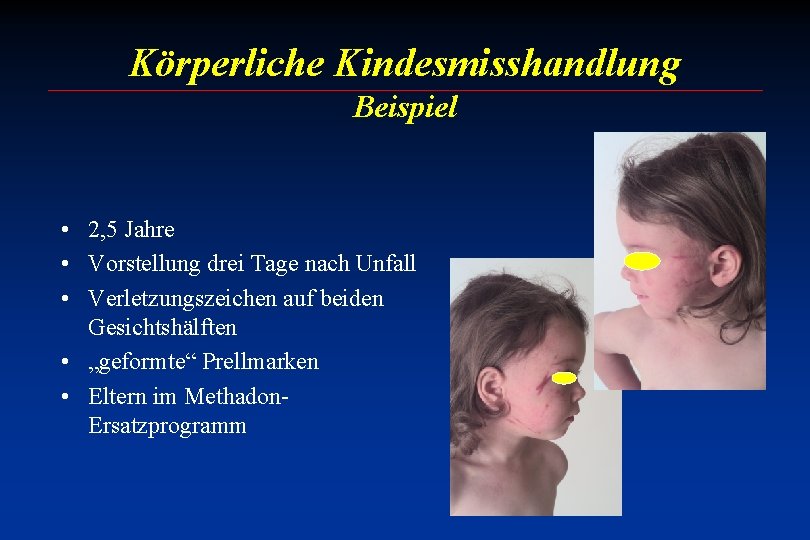 Körperliche Kindesmisshandlung Beispiel • 2, 5 Jahre • Vorstellung drei Tage nach Unfall •