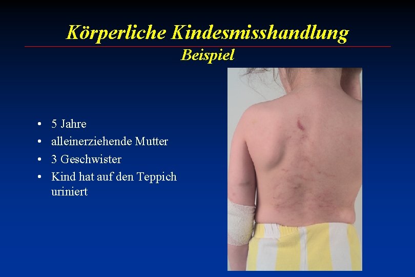 Körperliche Kindesmisshandlung Beispiel • • 5 Jahre alleinerziehende Mutter 3 Geschwister Kind hat auf