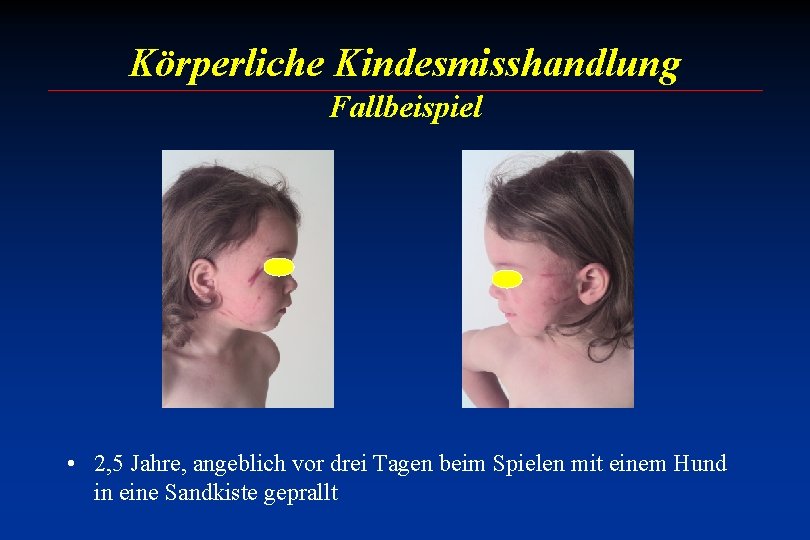 Körperliche Kindesmisshandlung Fallbeispiel • 2, 5 Jahre, angeblich vor drei Tagen beim Spielen mit