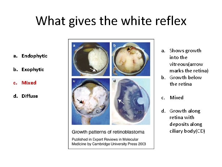 What gives the white reflex c. Mixed a. Shows growth into the vitreous(arrow marks