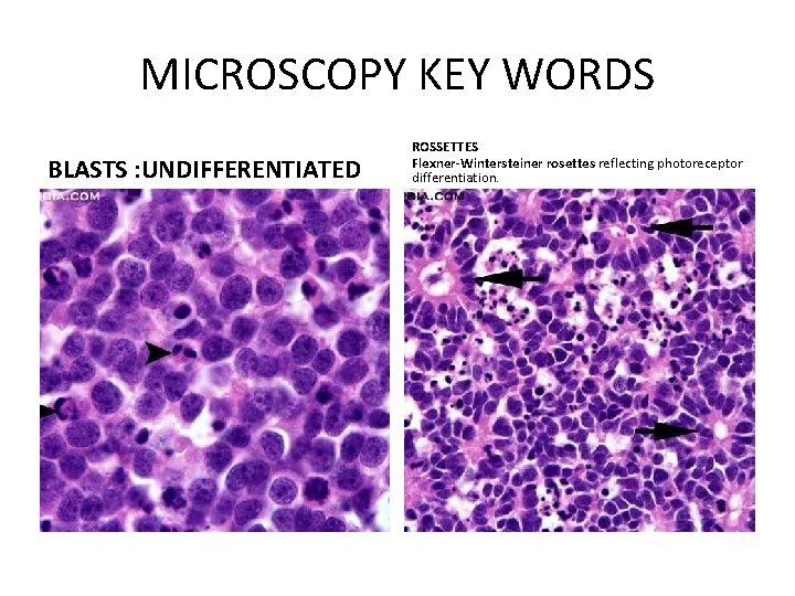 MICROSCOPY KEY WORDS BLASTS : UNDIFFERENTIATED ROSSETTES Flexner-Wintersteiner rosettes reflecting photoreceptor differentiation. 