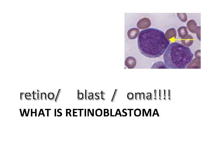 retino/ blast / oma!!!! WHAT IS RETINOBLASTOMA 