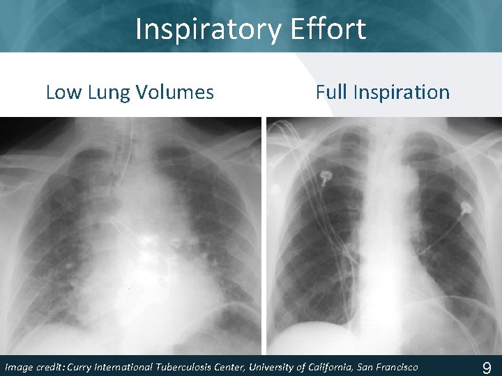 Inspiratory Effort Low Lung Volumes Full Inspiration Image Tuberculosis Center, University of California, San