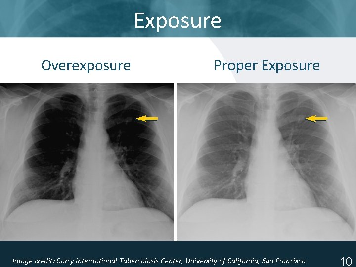 Exposure Overexposure Proper Exposure Image credit: Curry International Tuberculosis Center, University of California, San