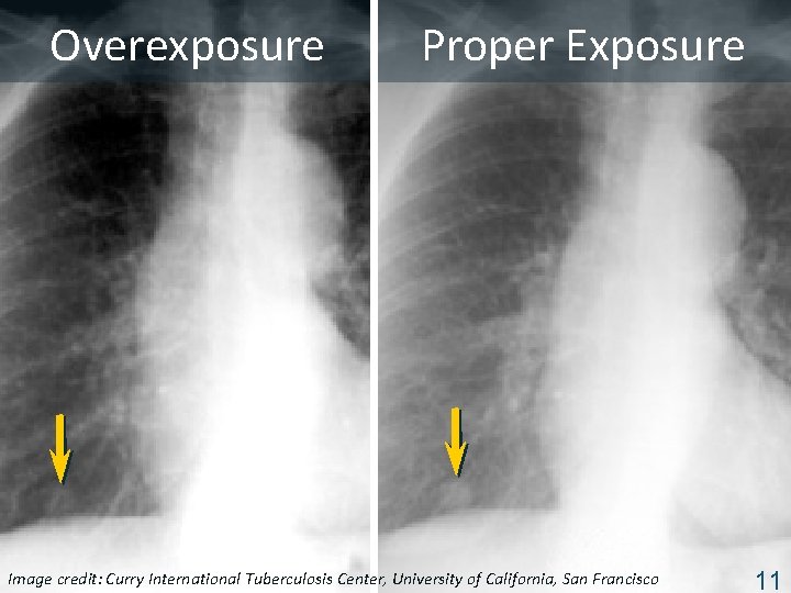 Overexposure Proper Exposure Image Tuberculosis Center, University of California, San Francisco ISTC TBcredit: Training