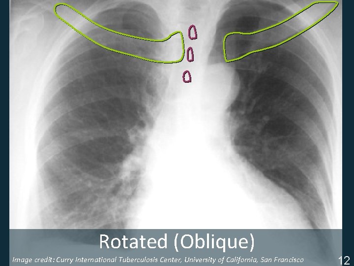 Rotated (Oblique) Image credit: Curry International Tuberculosis Center, University of California, San Francisco ISTC