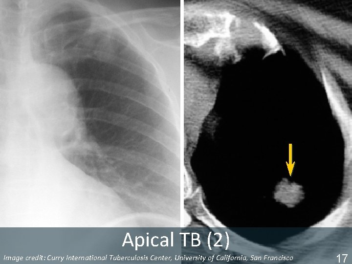 Apical TB (2) Image Tuberculosis Center, University of California, San Francisco ISTC TBcredit: Training
