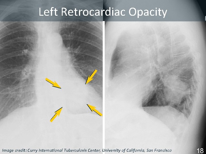 Left Retrocardiac Opacity Image Tuberculosis Center, University of California, San Francisco ISTC TBcredit: Training