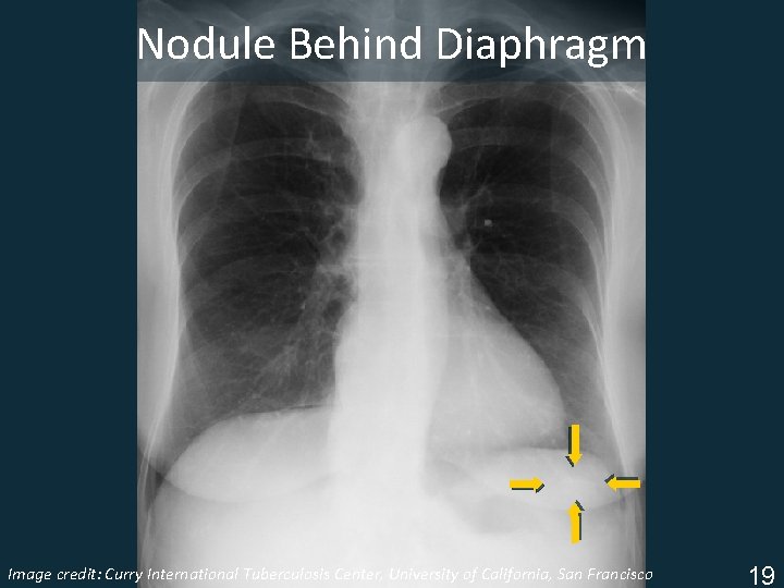 Nodule Behind Diaphragm Image Tuberculosis Center, University of California, San Francisco ISTC TBcredit: Training