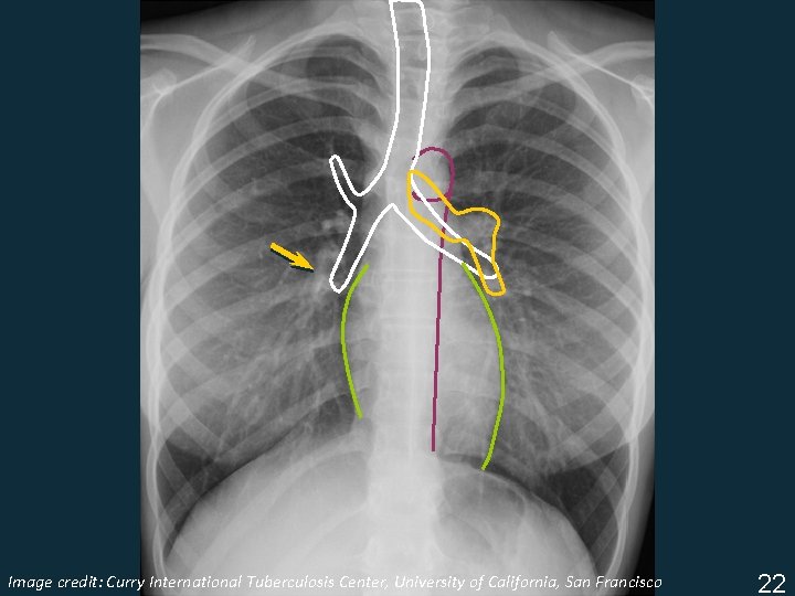 Image Tuberculosis Center, University of California, San Francisco ISTC TBcredit: Training Curry Modules. International