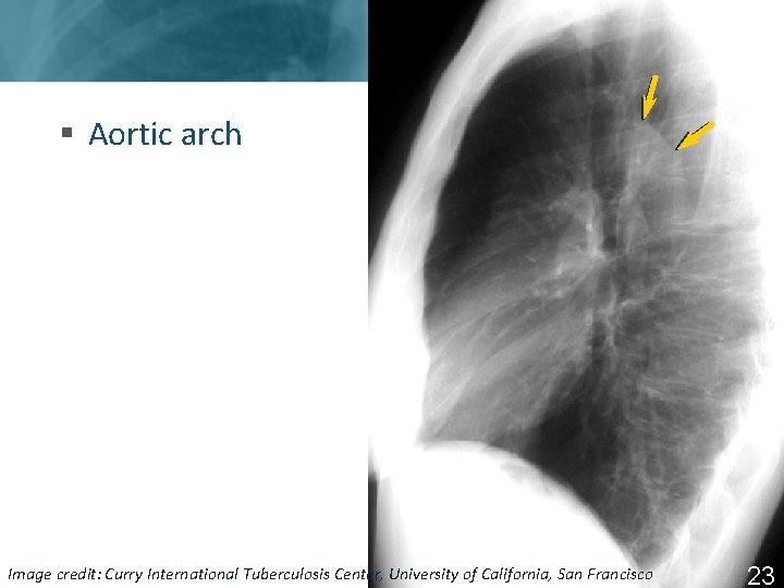 § Aortic arch Image Tuberculosis Center, University of California, San Francisco ISTC TBcredit: Training